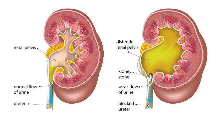 治疗|1258颗结石从体内取出，无症状？或是这3个症状，你而不自知