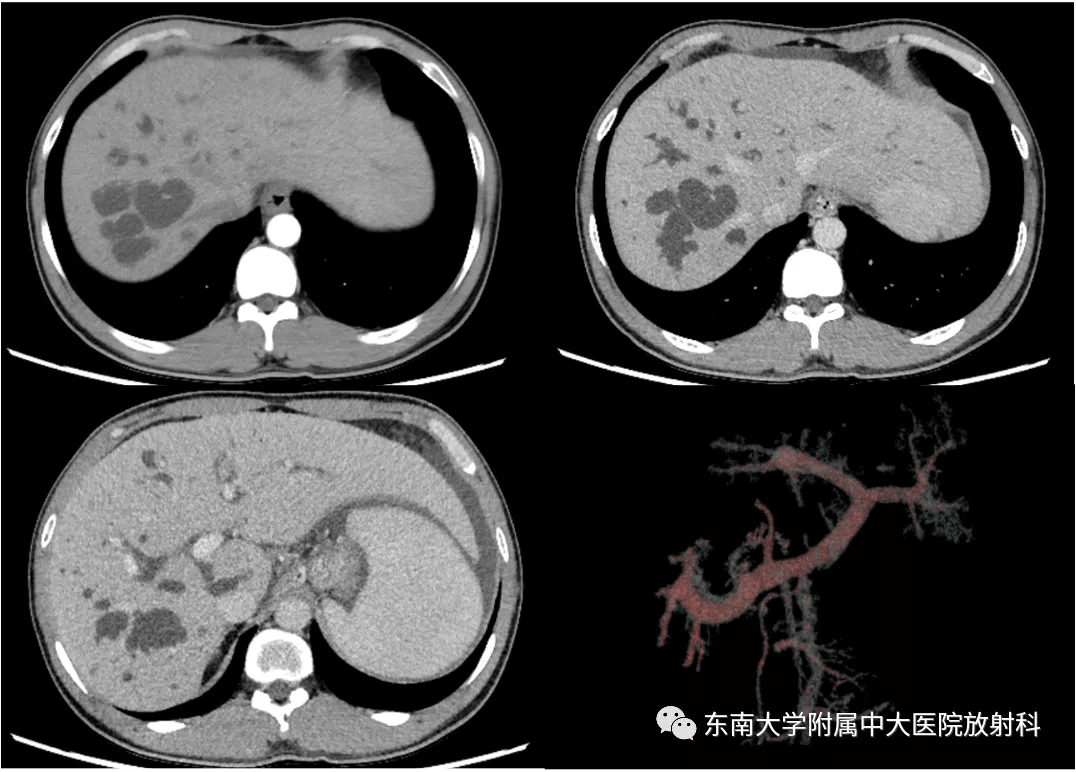 一学就会caroli病影像及临床表现