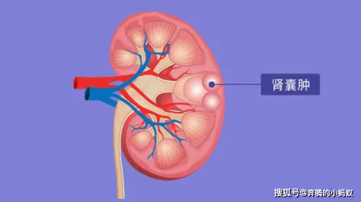 出现腹部肿块疼痛,高血压等7大症状需小心肾囊肿!_肾脏_治疗_疾病