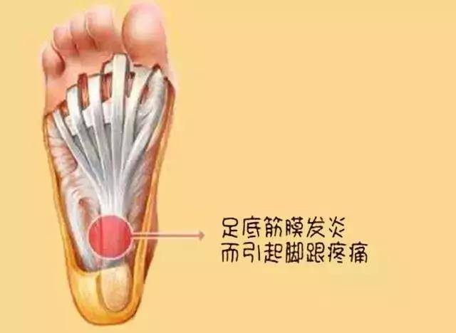 鼎翼科普保护好双脚小心足底筋膜炎