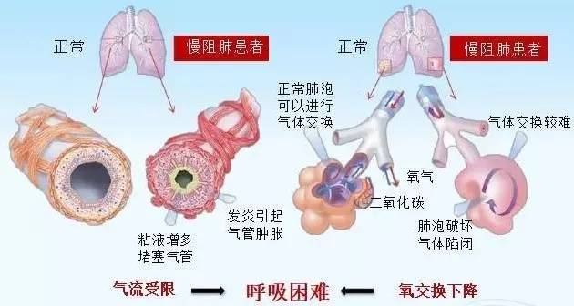 治疗|疾控话健康|共抗慢阻肺