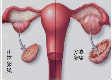 综合征|月经不调、多毛痤疮、不孕……警惕，可能是这个内分泌疾病在作祟！