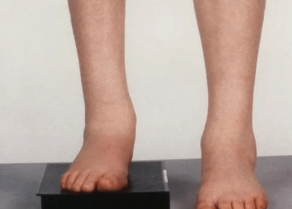 长短腿其实跟我们的腰有很大的关系_骨盆_磨损_双下肢