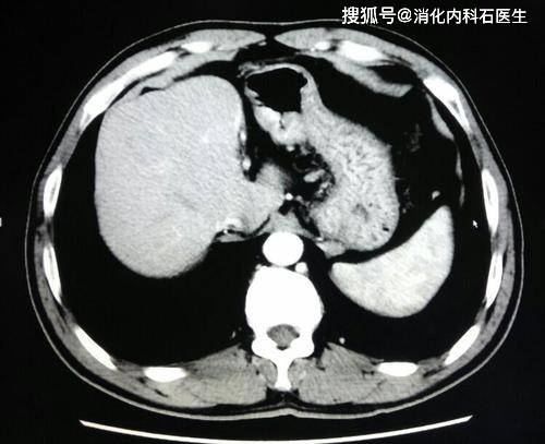 青年从确诊胃癌到去世只用了7天医生真正病因比胃癌还凶猛