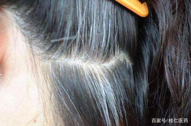 小小年纪就有白头发了？这3个原因不容忽视