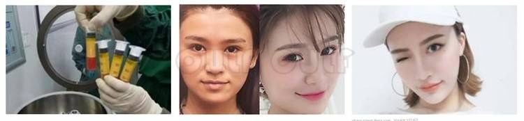 脸部脸部脂肪填充有风险吗、脂肪填充的危害有哪些、不敢看~