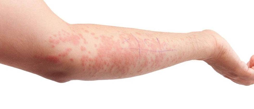 症状|皮肤上出现这些症状是糖尿病发出的信号，请仔细看，女性更要注意