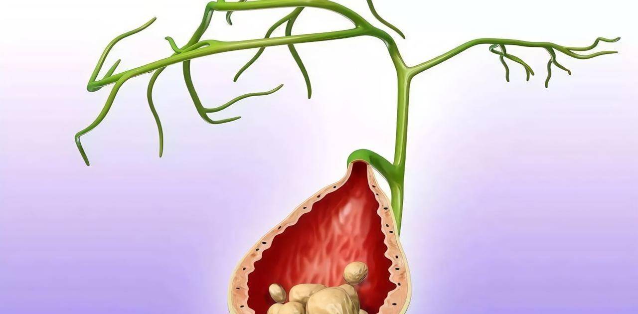 食品|胆结石最“喜欢”4种人，每一种都很常见，但愿你不在其列