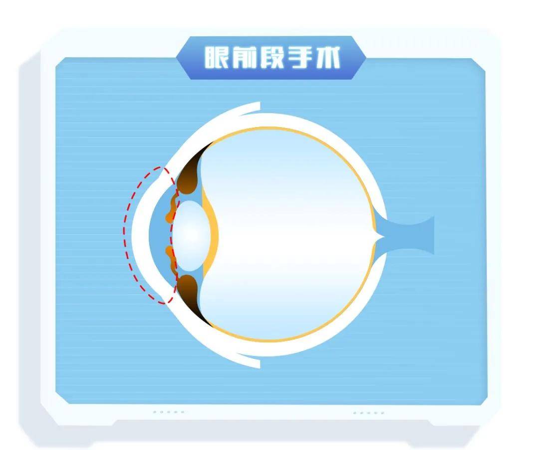 晶立方沉浸式视力康养 | 近视手术不是视力问题的克