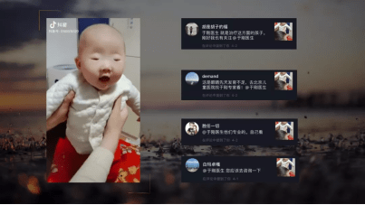 手术|五年八部曲，上睑下垂分阶段治疗的故事