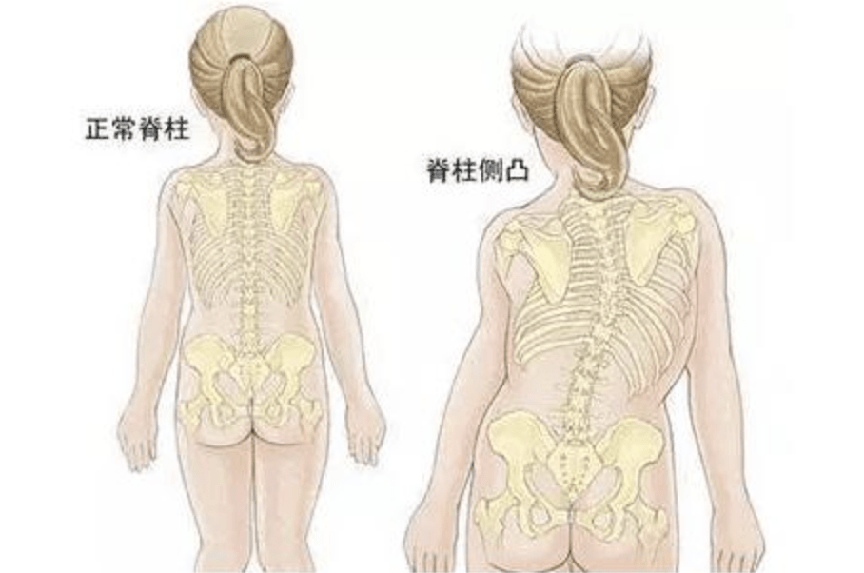 孩子整体弯腰驼背,不要着急打骂,也可能是脊柱侧弯在作怪_小孩_家长