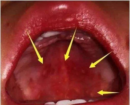 牙龈出现红色血点图片