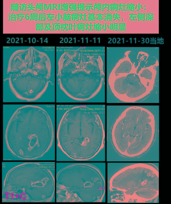 阴性|探案丨是“谁”在我脑子里打散了荷包蛋？