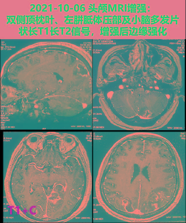 阴性|探案丨是“谁”在我脑子里打散了荷包蛋？