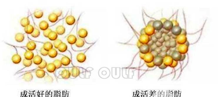 三个阶段脂肪填充一次可以成功吗?脂肪填充图片效果好,来看看
