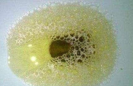 症状|尿液出现3种“泡沫”，早点去医院做检查，当心是疾病的信号