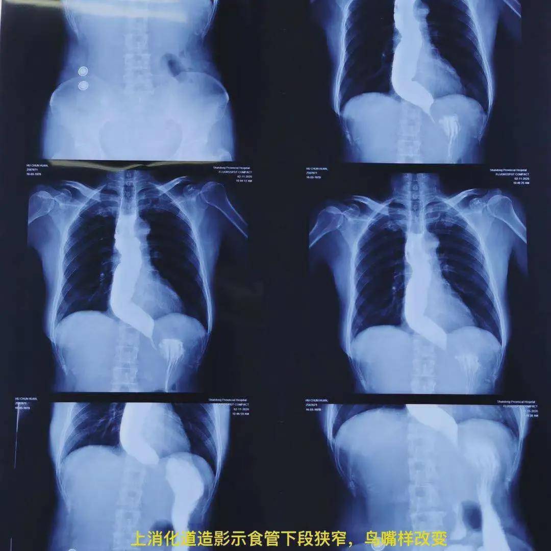 就反复发生恶心呕吐,伴有胸骨后疼痛和进食梗噎感,最近一个月症状加重