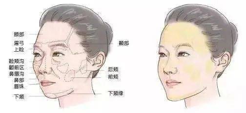 禁忌面部轮廓不流畅，填充还要分情况，太阳穴填充有什么禁忌？