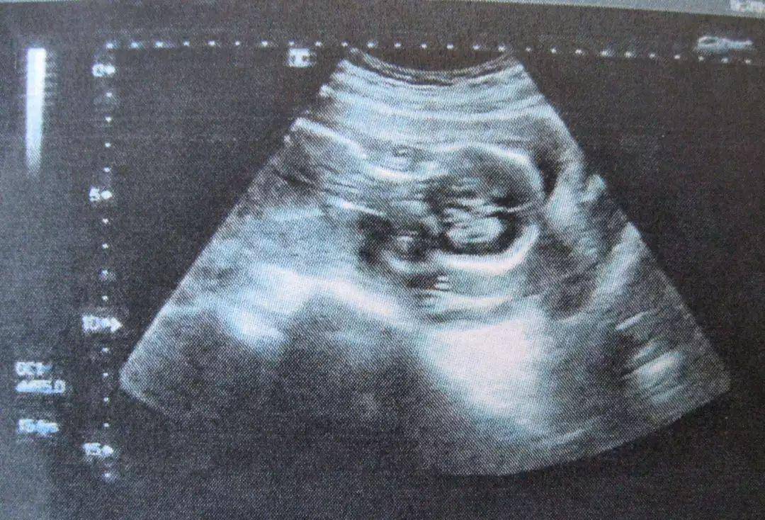 症状|肝豆状核变性伴发的精神障碍，会出现智力下降，以及脾肝肿大