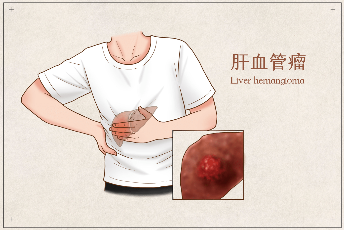 发现肝血管瘤应该怎么做