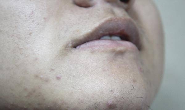 生活|肝脏不好，先上脸！脸上有4个变化，预示肝病上身，尽早查肝功能