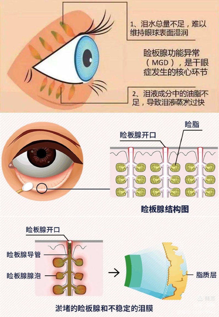 干眼症图图片