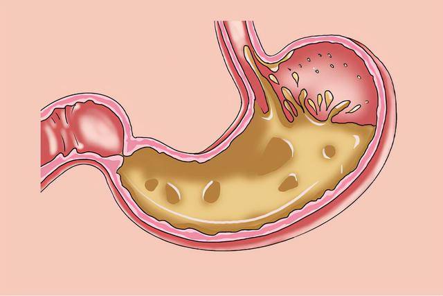 烧心|患有胃食管反流，咽喉处的表现有何特点？听听医生怎么说