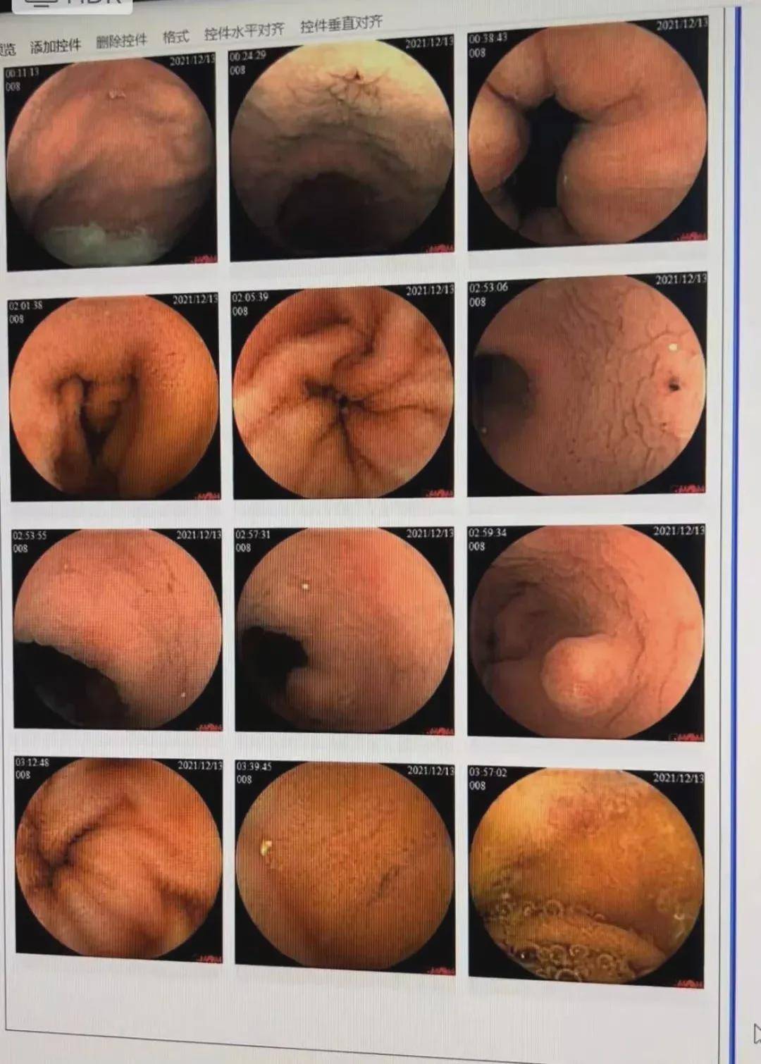 小肠胶囊内镜经历图片