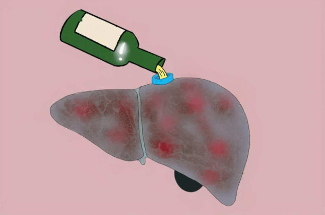 北京古楼疑难病研究院刘长城:酒精性肝硬化的症状有哪些_患者_方面