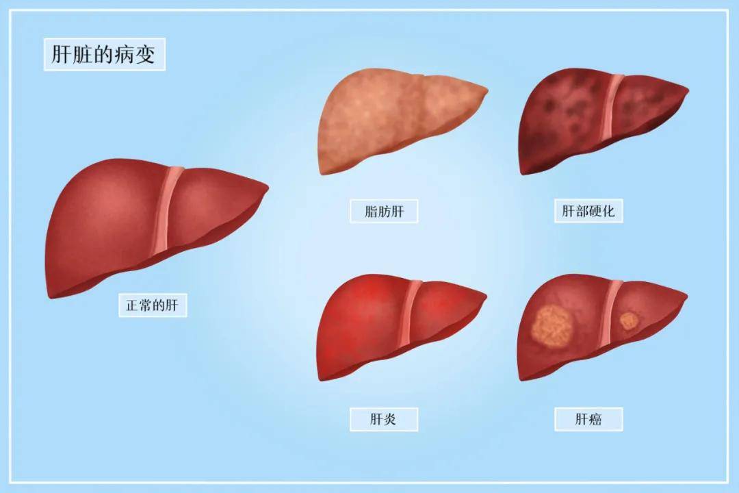 肾脏|这两大身体“哑巴器官”，氢来护！