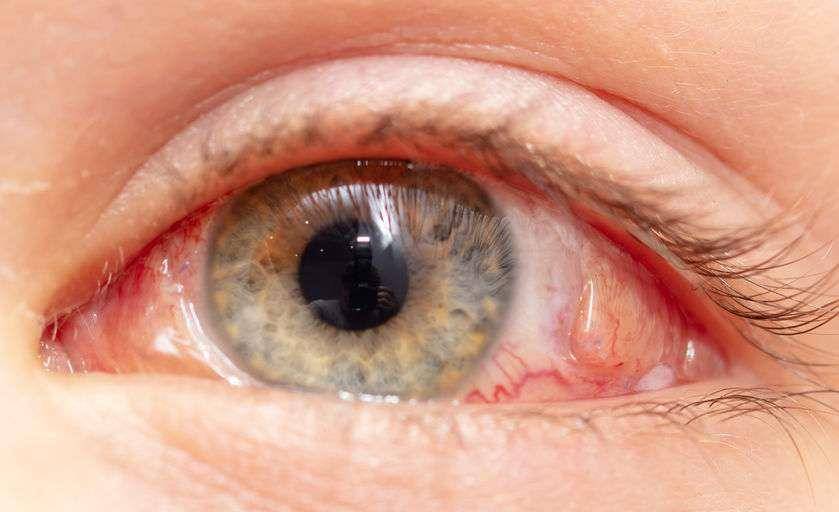 肝脏|患上肝病，脸上先知，提醒，出现这5个体征，是肝病的先兆