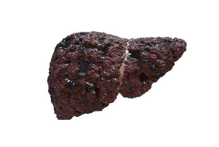 症状|身体出现这5个症状,肝脏也许已经病变,这款国产药有疗效