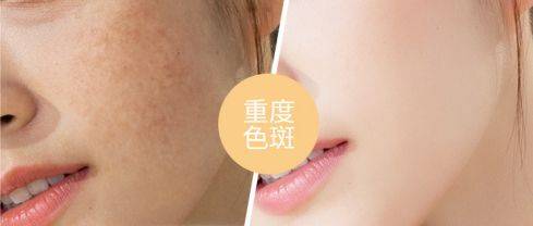 人群黛维依祛斑是真的_想要去掉脸上的斑,好用又少折腾的办法分享给你