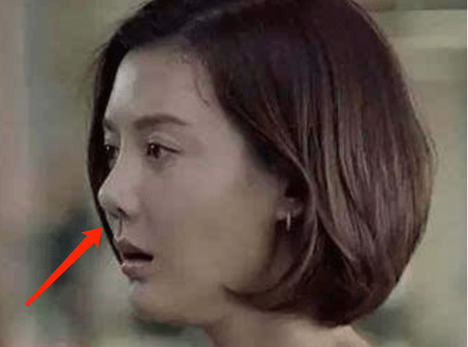后遗症那些乱整鼻子的女星还好吗？后遗症一大堆，杨幂金晨都开始崩了