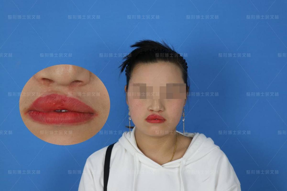 唇裂二期红唇修复可以达到什么效果?_畸形_组织_手术