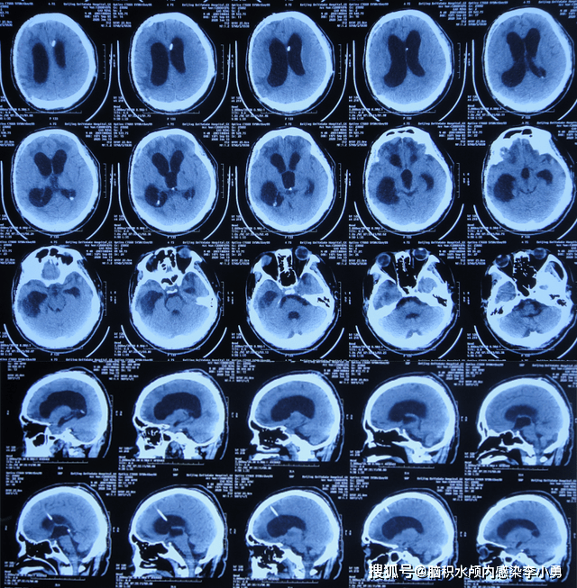 脑外伤脑积水脑膨出先后行分流术电子脑室镜术颅骨修补术后加重颅内