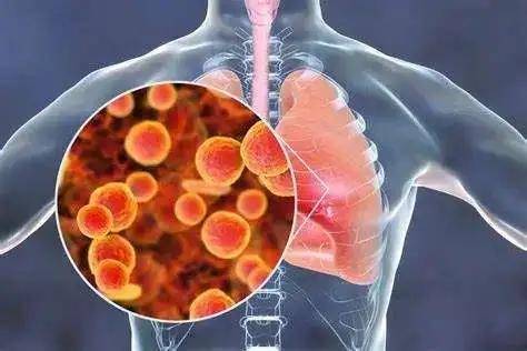 患儿|肺炎支原体感染频发，这些问题一定要知道！