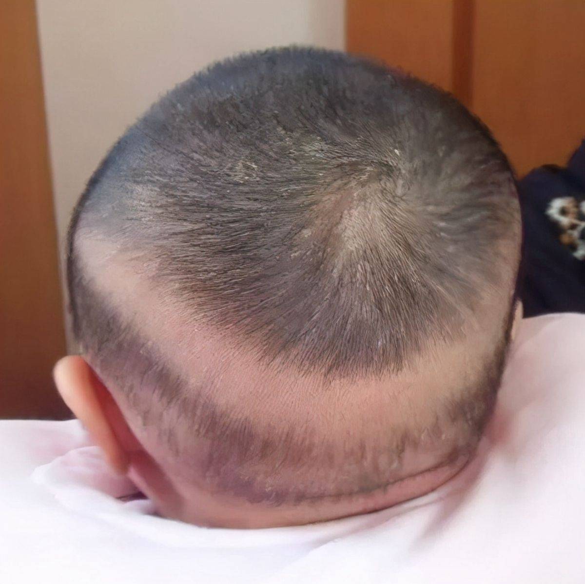 如何预防新生儿斑秃？