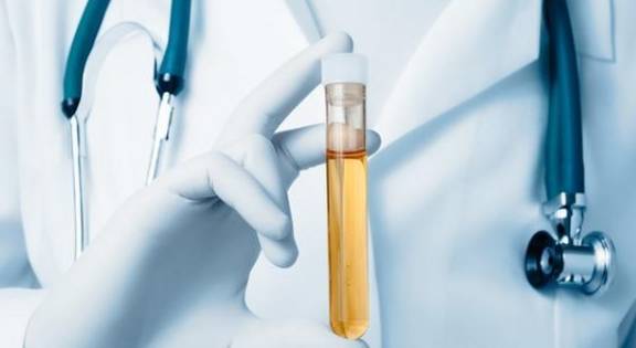 肾脏|肾友注意:保持肾功能稳定,除了蛋白尿,这项尿液指标也要重视