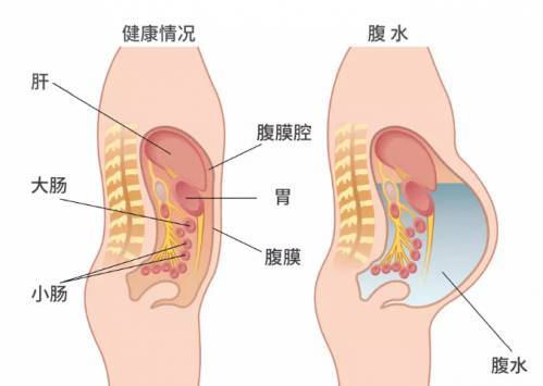 肝腹水能活多久？