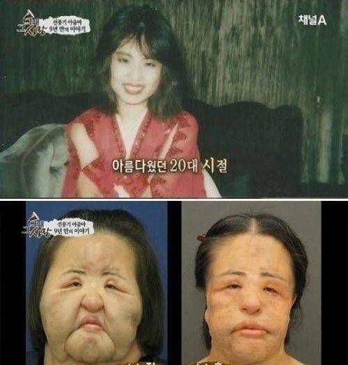 对比整容后遗症有多可怕？中美韩明星脸部塌房对比图，有些脸都认不出