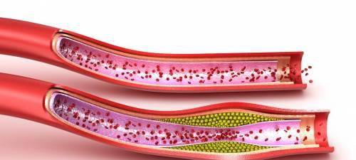 忠告|脑梗多是吃出来的，医生忠告：早餐少吃这2样，太伤血管了