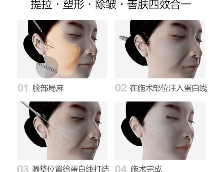 脸部解析:脸部线雕多大年龄做最合适?脸部做线雕一般几天恢复?