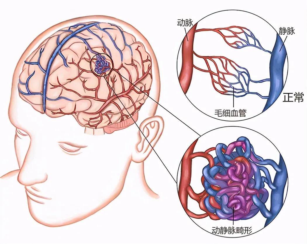 畸形|当11岁女孩巧遇这对“缠绵恋人” 看神经外科专家如何一招制胜