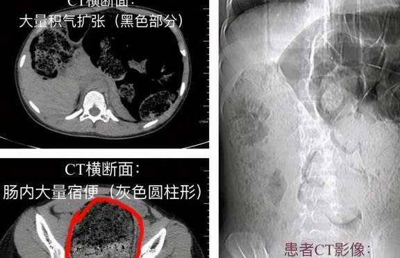 帶著疑問,賀曉旭趕快看了一下全腹部ct平掃——確實是腸梗阻,但還有更