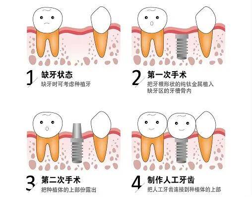 活动义齿价目表 5457d89f200a4dfdb362b4589c1f012f.jpeg