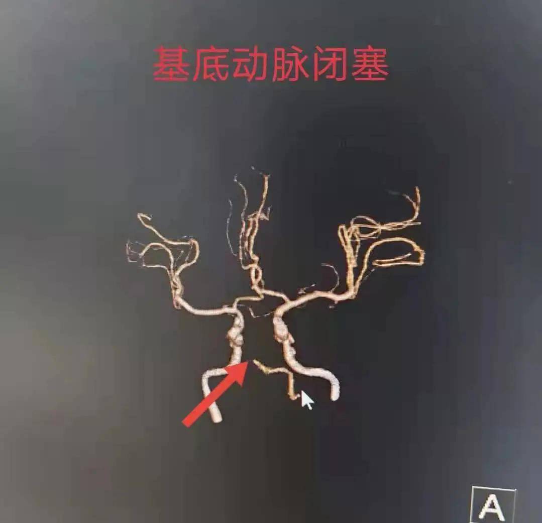 成功|惊险！基底动脉闭塞命悬一线 急诊神经介入打通“生命中枢”