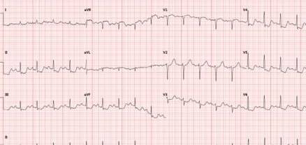 甲状腺|“医生，我胸痛2天、血压185/92 mmHg！怎么回事？”