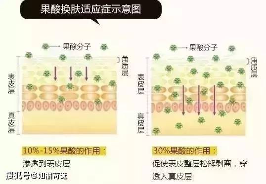 果酸女孩挤痘痘诱发败血症?祛痘千万不能做的那些事儿！纯干货祛痘指南分享!