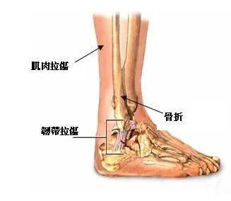 伤筋动骨的图片大全图片